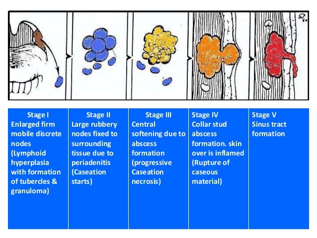 Tubercular lymphadenitis management diagram for lymphoma staging 