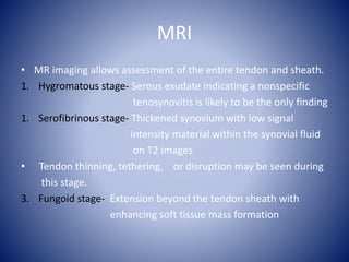 MRI
• MR imaging allows assessment of the entire tendon and sheath.
1. Hygromatous stage- Serous exudate indicating a nonspecific
tenosynovitis is likely to be the only finding
1. Serofibrinous stage- Thickened synovium with low signal
intensity material within the synovial fluid
on T2 images
• Tendon thinning, tethering, or disruption may be seen during
this stage.
3. Fungoid stage- Extension beyond the tendon sheath with
enhancing soft tissue mass formation
 