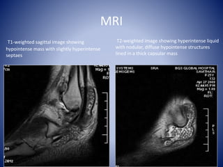 MRI
T1-weighted sagittal image showing
hypointense mass with slightly hyperintense
septaes
T2-weighted image showing hyperintense liquid
with nodular, diffuse hypointense structures
lined in a thick capsular mass
 