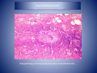Histopathology showing large granuloma of epitheloid cells.
HISTOPATHOLOGY
 