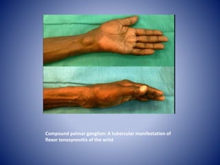 Compound palmar ganglion: A tubercular manifestation of
flexor tenosynovitis of the wrist
 
