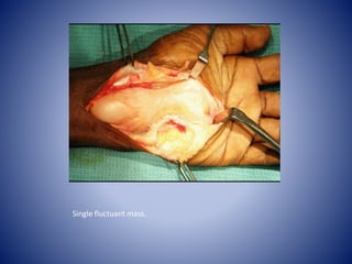 Single fluctuant mass.
 