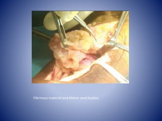 Fibrinous material and Melon seed bodies.
 