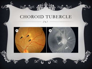CHOROID TUBERCLE
 