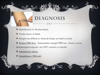 DIAGNOSIS
 Identification of M.tuberculosis
 Ocular tissues or fluids.
 Samples are difficult to obtain & biopsy are hard to justify.
 Positive PPD Test : Intermediate strength PPD test : shows a severe
dermatological response- not 100% sensitive or specific.
 Interferon-γ- release
 Quantiferon – TB Gold .
 