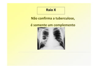 Raio X

Não confirma a tuberculose,
é somente um complemento
 