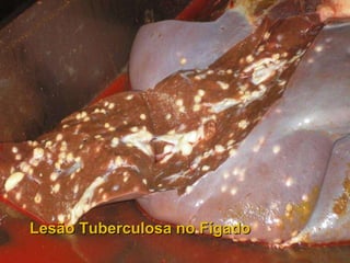 Lesão Tuberculosa no Fígado 