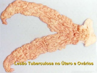 Lesão Tuberculosa no Útero e Ovários 