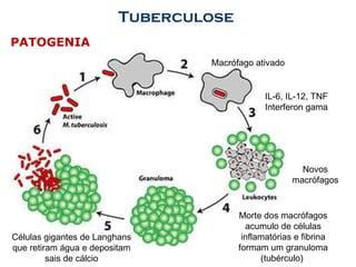PATOGENIA Tuberculose  Macrófago ativado IL-6, IL-12, TNF Interferon gama Novos macrófagos Morte dos macrófagos acumulo de células inflamatórias e fibrina formam um granuloma (tubérculo)  Células gigantes de Langhans que retiram água e depositam sais de cálcio 