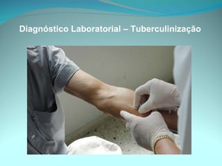 Diagnóstico Laboratorial – Tuberculinização 