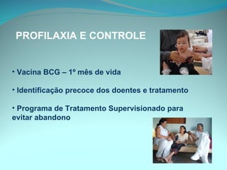 Vacina BCG – 1º mês de vida Identificação precoce dos doentes e tratamento Programa de Tratamento Supervisionado para evitar abandono PROFILAXIA E CONTROLE  