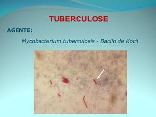 TUBERCULOSE AGENTE: Mycobacterium tuberculosis - Bacilo de Koch  