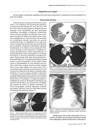 Capone D, Jansen JM, Lopes AJ et al . Diagnóstico por imagem da tuberculose




                                                   Diagnóstico por imagem

     De forma geral, as alterações radiológicas da tuberculose representam a tradução dos eventos patogênicos a
partir do contágio.
                                                      Tuberculose primária
      O bacilo de Koch atinge primariamente os pul-
mões e, em indivíduos não previamente expostos,
é responsável pela doença em cerca de 5% a 15%
dos casos. Uma vez alcançados os alvéolos, há uma
resposta inicial inespecífica da qual participam
neutrófilos, macrófagos e linfócitos, constituindo
o foco inicial ou primário da infecção. Como a pri-
meira tentativa de defesa não obtém êxito, os ba-
cilos multiplicam-se e este processo inicial resulta
em consolidação alveolar, que pode ser extensa,
envolvendo parte ou totalidade de um lobo pul-
monar. A progressão da infecção ocorre localmente
por via linfática, atingindo os linfonodos regionais
(mediastinais e/ou hilares). Esta progressão linfá-
tica em direção ao hilo pulmonar e mediastino é
própria da tuberculose e pode, eventualmente, ser
supreendida pelo exame radiográfico ou tomográ-
fico (Figura 1). Uma vez constituído o complexo pri-
mário representado pelo pólo parenquimatoso e
linfonodal (Figura 2), a progressão da doença pode
ocorrer a partir de qualquer um dos pólos, sendo
várias as possibilidades na rota hemática dos ba-
cilos, entre elas o sistema nervoso central, medula
óssea, ossos, baço, fígado, rins, entre outros. Pou-                   Figura 2 – Complexo primário. TC registrada em janela de parênquima
cas semanas após a infecção inicial entram em cena                     (“A”) demonstra opacidade nodular justapleural no lobo superior direito
mecanismos específicos de defesa, mediados pelos                       que representa o pólo parenquimatoso da tuberculose. Em “B”, observa-
linfócitos T, os únicos capazes de deter a infecção e                  se massa de linfonodos com centro hipodenso na região retrocava.
a multiplicação bacilar. Daí em diante, as alterações
patológicas dependerão do balanço entre a ação do
bacilo versus a imunidade e a reação de hipersen-
sibilidade por parte do hospedeiro. Indivíduos que
mantêm preservados seus mecanismos de defesa
são capazes de conter os bacilos confinados em
focos encapsulados, advindo alterações residuais
que podem calcificar, tanto nos linfonodos quanto
no parênquima pulmonar (Figura 3).




                                                                       Figura 3 – Tuberculose residual. Radiograﬁa em PA revela múltiplos
                                                                       nódulos calciﬁcados associados a linfonodos também calciﬁcados
Figura 1 – Disseminação linfática. Em “A”, TC registrada em janela     no hilo esquerdo.
de parênquima demonstra opacidades de limites imprecisos lo-
calizada no lobo superior direito, exibindo disseminação linfática
                                                                            Indivíduos que não mantêm preservados seus me-
local em direção ao hilo pulmonar, também visualizada na janela        canismos de defesa não são capazes de oferecer resposta
mediastinal (“B”).                                                     imune adequada ao bacilo da tuberculose e a infecção pri-

                                                                                                            Pulmão RJ 2006;15(3):166-174   167
 