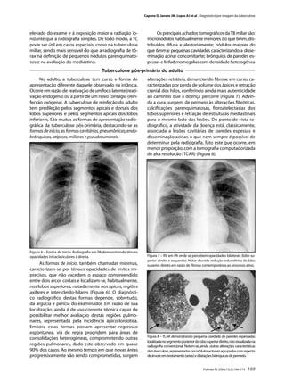 Capone D, Jansen JM, Lopes AJ et al . Diagnóstico por imagem da tuberculose




elevado do exame e à exposição maior a radiação io-                       Os principais achados tomográﬁcos da TB miliar são:
nizante que a radiograﬁa simples. De todo modo, a TC                 micronódulos habitualmente menores do que 6mm, dis-
pode ser útil em casos especiais, como na tuberculose                tribuídos difusa e aleatoriamente; nódulos maiores do
miliar, sendo mais sensível do que a radiograﬁa de tó-               que 6mm e pequenas cavidades caracterizando a disse-
rax na deﬁnição de pequenos nódulos parenquimato-                    minação acinar concomitante; brônquios de paredes es-
sos e na avaliação do mediastino.                                    pessas e linfadenomegalias com densidade heterogênea
                                          Tuberculose pós-primária do adulto
      No adulto, a tuberculose tem curso e forma de                  alterações retráteis, denunciando ﬁbrose em curso, ca-
apresentação diferente daquele observado na infância.                racterizadas por perda de volume dos ápices e retração
Ocorre em razão de reativação de um foco latente (reati-             cranial dos hilos, conferindo ainda mais autenticidade
vação endógena) ou a partir de um novo contágio (rein-               ao caminho que a doença percorre (Figura 7). Advin-
fecção exógena). A tuberculose de reinfeção do adulto                da a cura, surgem, de permeio às alterações ﬁbróticas,
tem predileção pelos segmentos apicais e dorsais dos                 calciﬁcações parenquimatosas, ﬁbroatelectasias dos
lobos superiores e pelos segmentos apicais dos lobos                 lobos superiores e retração de estruturas mediastinais
inferiores. São muitas as formas de apresentação radio-              para o mesmo lado das lesões. Do ponto de vista ra-
gráﬁca da tuberculose pós-primária, destacando-se as                 diográﬁco, a atividade da doença está, classicamente,
formas de início, as formas cavitárias, pneumônicas, endo-           associada a lesões cavitárias de paredes espessas e
brônquicas, atípicas, miliares e pseudotumorais.                     disseminação acinar, o que nem sempre é possível de
                                                                     determinar pela radiograﬁa, fato este que ocorre, em
                                                                     menor proporção, com a tomograﬁa computadorizada
                                                                     de alta resolução (TCAR) (Figura 8).




Figura 6 – Forma de início. Radiograﬁa em PA demonstrando tênues
opacidades infraclaviculares à direita.                              Figura 7 – RX em PA onde se percebem opacidades bilaterais (lobo su-
                                                                     perior direito e esquerdo). Notar discreta redução volumétrica do lobo
     As formas de início, também chamadas mínimas,                   superior direito em razão de ﬁbrose contemporânea ao processo ativo.
caracterizam-se por tênues opacidades de imites im-
precisos, que não excedem o espaço compreendido
entre dois arcos costais e localizam-se, habitualmente,
nos lobos superiores, notadamente nos ápices, regiões
axilares e inter-cleido-hilares (Figura 6). O diagnósti-
co radiográﬁco destas formas depende, sobretudo,
da argúcia e perícia do examinador. Em razão de sua
localização, ainda é de uso corrente técnica capaz de
possibilitar melhor avaliação destas regiões pulmo-
nares, representada pela incidência ápico-lordótica.
Embora estas formas possam apresentar regressão
espontânea, via de regra progridem para áreas de
consolidações heterogêneas, comprometendo outras                     Figura 8 – TCAR demonstrando pequena cavidade de paredes espessadas
                                                                     localizada no segmento posterior do lobo superior direito, não visualizada na
regiões pulmonares, dado este observado em quase                     radiograﬁa convencional. Notam-se, ainda, outras alterações características
90% dos casos. Ao mesmo tempo em que novas áreas                     da tuberculose, representadas por nódulos acinares agrupados com aspecto
progressivamente vão sendo comprometidas, surgem                     de árvore em brotamento (setas) e dilatações brônquicas de permeio.


                                                                                                            Pulmão RJ 2006;15(3):166-174    169
 