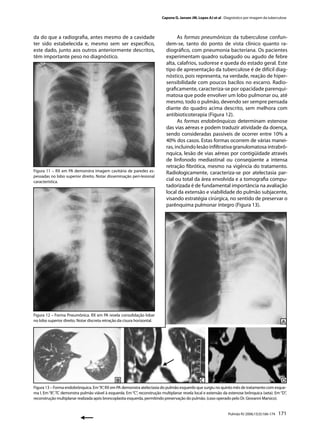 Capone D, Jansen JM, Lopes AJ et al . Diagnóstico por imagem da tuberculose




da do que a radiograﬁa, antes mesmo de a cavidade                                  As formas pneumônicas da tuberculose confun-
ter sido estabelecida e, mesmo sem ser especíﬁco,                            dem-se, tanto do ponto de vista clínico quanto ra-
este dado, junto aos outros anteriormente descritos,                         diográﬁco, com pneumonia bacteriana. Os pacientes
têm importante peso no diagnóstico.                                          experimentam quadro subagudo ou agudo de febre
                                                                             alta, calafrios, sudorese e queda do estado geral. Este
                                                                             tipo de apresentação da tuberculose é de difícil diag-
                                                                             nóstico, pois representa, na verdade, reação de hiper-
                                                                             sensibilidade com poucos bacilos no escarro. Radio-
                                                                             graﬁcamente, caracteriza-se por opacidade parenqui-
                                                                             matosa que pode envolver um lobo pulmonar ou, até
                                                                             mesmo, todo o pulmão, devendo ser sempre pensada
                                                                             diante do quadro acima descrito, sem melhora com
                                                                             antibioticoterapia (Figura 12).
                                                                                   As formas endobrônquicas determinam estenose
                                                                             das vias aéreas e podem traduzir atividade da doença,
                                                                             sendo consideradas passíveis de ocorrer entre 10% a
                                                                             40% dos casos. Estas formas ocorrem de várias manei-
                                                                             ras, incluindo lesão inﬁltrativa granulomatosa intrabrô-
                                                                             nquica, lesão de vias aéreas por contigüidade através
                                                                             de linfonodo mediastinal ou conseqüente a intensa
                                                                             retração ﬁbrótica, mesmo na vigência do tratamento.
Figura 11 – RX em PA demonstra imagem cavitária de paredes es-               Radiologicamente, caracteriza-se por atelectasia par-
pessadas no lobo superior direito. Notar disseminação peri-lesional
característica.
                                                                             cial ou total da área envolvida e a tomograﬁa compu-
                                                                             tadorizada é de fundamental importância na avaliação
                                                                             local da extensão e viabilidade do pulmão subjacente,
                                                                             visando estratégia cirúrgica, no sentido de preservar o
                                                                             parênquima pulmonar íntegro (Figura 13).




Figura 12 – Forma Pneumônica. RX em PA revela consolidação lobar
no lobo superior direito. Notar discreta retração da cisura horizontal.




Figura 13 – Forma endobrônquica. Em “A”, RX em PA demonstra atelectasia do pulmão esquerdo que surgiu no quinto mês de tratamento com esque-
ma I. Em “B”, TC demonstra pulmão viável à esquerda. Em “C”, reconstrução multiplanar revela local e extensão da estenose brônquica (seta). Em “D”,
reconstrução multiplanar realizada após broncoplastia esquerda, permitindo preservação do pulmão. (caso operado pelo Dr. Giovanni Marsico).


                                                                                                                 Pulmão RJ 2006;15(3):166-174   171
 