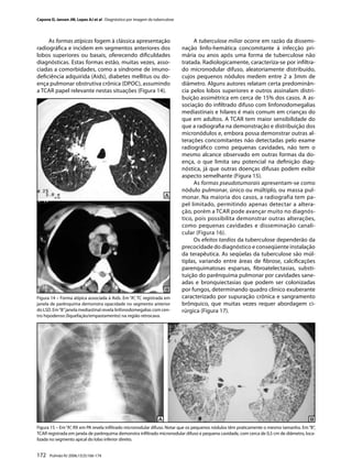 Capone D, Jansen JM, Lopes AJ et al . Diagnóstico por imagem da tuberculose




     As formas atípicas fogem à clássica apresentação                              A tuberculose miliar ocorre em razão da dissemi-
radiográﬁca e incidem em segmentos anteriores dos                             nação linfo-hemática concomitante à infecção pri-
lobos superiores ou basais, oferecendo diﬁculdades                            mária ou anos após uma forma de tuberculose não
diagnósticas. Estas formas estão, muitas vezes, asso-                         tratada. Radiologicamente, caracteriza-se por inﬁltra-
ciadas a comorbidades, como a síndrome de imuno-                              do micronodular difuso, aleatoriamente distribuído,
deﬁciência adquirida (Aids), diabetes mellitus ou do-                         cujos pequenos nódulos medem entre 2 a 3mm de
ença pulmonar obstrutiva crônica (DPOC), assumindo                            diâmetro. Alguns autores relatam certa predominân-
a TCAR papel relevante nestas situações (Figura 14).                          cia pelos lobos superiores e outros assinalam distri-
                                                                              buição assimétrica em cerca de 15% dos casos. A as-
                                                                              sociação do inﬁltrado difuso com linfonodomegalias
                                                                              mediastinais e hilares é mais comum em crianças do
                                                                              que em adultos. A TCAR tem maior sensibilidade do
                                                                              que a radiograﬁa na demonstração e distribuição dos
                                                                              micronódulos e, embora possa demonstrar outras al-
                                                                              terações concomitantes não detectadas pelo exame
                                                                              radiográﬁco como pequenas cavidades, não tem o
                                                                              mesmo alcance observado em outras formas da do-
                                                                              ença, o que limita seu potencial na deﬁnição diag-
                                                                              nóstica, já que outras doenças difusas podem exibir
                                                                              aspecto semelhante (Figura 15).
                                                                                   As formas pseudotumorais apresentam-se como
                                                                              nódulo pulmonar, único ou múltiplo, ou massa pul-
                                                                              monar. Na maioria dos casos, a radiografia tem pa-
                                                                              pel limitado, permitindo apenas detectar a altera-
                                                                              ção, porém a TCAR pode avançar muito no diagnós-
                                                                              tico, pois possibilita demonstrar outras alterações,
                                                                              como pequenas cavidades e disseminação canali-
                                                                              cular (Figura 16).
                                                                                   Os efeitos tardios da tuberculose dependerão da
                                                                              precocidade do diagnóstico e conseqüente instalação
                                                                              da terapêutica. As seqüelas da tuberculose são múl-
                                                                              tiplas, variando entre áreas de ﬁbrose, calciﬁcações
                                                                              parenquimatosas esparsas, ﬁbroatelectasias, substi-
                                                                              tuição do parênquima pulmonar por cavidades sane-
                                                                              adas e bronquiectasias que podem ser colonizadas
                                                                              por fungos, determinando quadro clínico exuberante
Figura 14 – Forma atípica associada à Aids. Em “A”, TC registrada em          caracterizado por supuração crônica e sangramento
janela de parênquima demonstra opacidade no segmento anterior                 brônquico, que muitas vezes requer abordagem ci-
do LSD. Em “B” janela mediastinal revela linfonodomegalias com cen-           rúrgica (Figura 17).
tro hipodenso (liquefação/empastamento) na região retrocava.




Figura 15 – Em “A”, RX em PA revela inﬁltrado micronodular difuso. Notar que os pequenos nódulos têm praticamente o mesmo tamanho. Em “B”,
TCAR registrada em janela de parênquima demonstra inﬁltrado micronodular difuso e pequena cavidade, com cerca de 0,5 cm de diâmetro, loca-
lizada no segmento apical do lobo inferior direito.


172    Pulmão RJ 2006;15(3):166-174
 