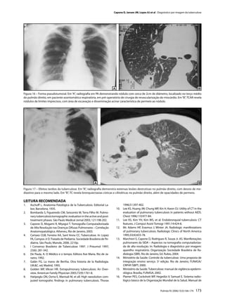 Capone D, Jansen JM, Lopes AJ et al . Diagnóstico por imagem da tuberculose




Figura 16 – Forma pseudotumoral. Em “A”, radiograﬁa em PA demonstrando nódulo com cerca de 2cm de diâmetro, localizado no terço médio
do pulmão direito, em paciente assintomática respiratória, em pré-operatório de cirurgia de revascularização do miocárdio. Em “B”, TCAR revela
nódulos de limites imprecisos, com área de escavação e disseminação acinar característica de permeio ao nódulo.




Figura 17 – Efeitos tardios da tuberculose. Em “A”, radiograﬁa demonstra extensas lesões destrutivas no pulmão direito, com desvio de me-
diastino para o mesmo lado. Em “B”, TC revela bronquiectasias císticas e cilíndricas no pulmão direito, além de opacidades de permeio.

LEITURA RECOMENDADA
1.   Aschoﬀ L. Anatomia Patológica de la Tuberculosis. Editorial La-              1996;51:397-402.
     bor, Barcelona, 1935.                                                  10.   Lee KS, Huang JW, Chung MP, Kin H, Kwon OJ. Utility of CT in the
2.   Bombarda S, Figueiredo CM, Seiscento M, Terra Filho M. Pulmo-                evaluation of pulmonary tuberculosis in patients without AIDS.
     nary tuberculosis:tomographic evaluation in the active and post-             Chest 1996;110:977-84.
     treatment phases. São Paulo Medical Jornal 2003; 121:198-202.          11.   Lee KS, Kim YH, Kim WS, et al: Endobronquial tuberculosis: CT
3.   Capone D, Mogami R, Miyagui T. Tomograﬁa Computadorizada                     features. J Comput Assist Tomogr 1991;14:424-8.
     de Alta Resolução nas Doenças Difusas Pulmonares – Correlação          12.   Mc Adams HP, Erasmus J, Winter JA. Radiologic manifestations
     Anatomopatológica. Atheneu, Rio de Janeiro, 2003.                            of pulmonary tuberculosis. Radiologic Clinics of North America
4.   Cartaxo CGB, Ferreira AA, Sant`Anna CC. Tuberculose. In: Lopez               1995;33(4):655-78.
     FA, Campos Jr D. Tratado de Pediatria. Sociedade Brasileira de Pe-     13.   Marchiori E, Capone D, Rodrigues R, Souza Jr. AS. Manifestações
     diatria. São Paulo, Manole, 2006. 2210p.                                     pulmonares da SIDA – Aspectos na tomograﬁa computadoriza-
5.   I Consenso Brasileiro de Tuberculose 1997. J Pneumol 1997;                   da de alta resolução. In: Radiologia e diagnóstico por imagem:
     23(6): 281-342.                                                              aparelho respiratório. Organização Sociedade Brasileira de Ra-
6.   De Paula, A. O Médico e o tempo. Editora Ave Maria, Rio de Ja-               diologia (SBR). Rio de Janeiro, Ed. Rubio, 2004.
     neiro, 1992.                                                           14.   Ministério da Saúde. Controle da tuberculose. Uma proposta de
7.   Galán FG. La mano de Bertha. Otra historia de la Radiología.                 integração ensino serviço. 5a edição. Rio de Janeiro, FUNASA/
     I.M.&C. ed, Madrid, 1995.                                                    CRPHF/SBPT, 2000.
8.   Golden MP, Vikran HR. Extrapulmonary tuberculosis: An Over-            15.   Ministério da Saúde. Tuberculose: manual de vigilância epidemi-
     view. American Family Physician 2005;72(9):1761-8.                           ológica. Brasília, FUNASA, 2002.
9.   Hatipoglu ON, Osma E, Manisali M, et all: High raesolution com-        16.   Plamer PES, Cockshott WP, Hegedüs V, Samuel E. Sistema radio-
     puted tomograhic ﬁndings in pulmonary tuberculosis. Thorax                   lógico básico de la Organização Mundial de la Salud. Manual de


                                                                                                                 Pulmão RJ 2006;15(3):166-174   173
 