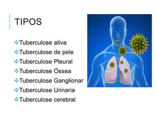 TIPOS
Tuberculose ativa
Tuberculose de pele
Tuberculose Pleural
Tuberculose Óssea
Tuberculose Ganglionar
Tuberculose Urinaria
Tuberculose cerebral

 