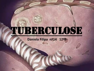 Tuberculose
Daniela Filipa nº14 12ºB

 