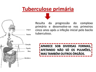 Tuberculose primária
Resulta da progressão do complexo
primário e desenvolve-se nos primeiros
cinco anos após a infeção inicial pelo bacilo
tuberculoso.

APARECE SOB DIVERSAS FORMAS,
AFETANDO NÃO SÓ OS PULMÕES,
MAS TAMBÉM OUTROS ÓRGÃOS.

 