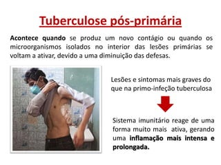 Tuberculose pós-primária
Acontece quando se produz um novo contágio ou quando os
microorganismos isolados no interior das lesões primárias se
voltam a ativar, devido a uma diminuição das defesas.
Lesões e sintomas mais graves do
que na primo-infeção tuberculosa

Sistema imunitário reage de uma
forma muito mais ativa, gerando
uma inflamação mais intensa e
prolongada.

 