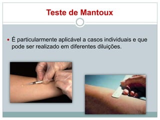 Teste de Mantoux

 É particularmente aplicável a casos individuais e que

pode ser realizado em diferentes diluições.

 