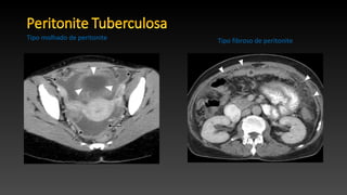 Tipo molhado de peritonite Tipo fibroso de peritonite
 