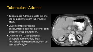 • Tuberculose Adrenal é visto em até
6% de pacientes com tuberculose
ativa.
• Quase sempre presente
envolvimento adrenal bilateral, com
quadro clínico de Addison.
• Os sinais de TC são glândulas
bilaterais aumentados, áreas
necróticas hipoatenuantes, com ou
sem calcificação.
 
