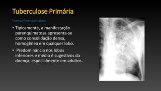 • Tipicamente, a manifestação
parenquimatosa apresenta-se
como consolidação densa,
homogênea em qualquer lobo.
• Predominância nos lobos
inferiores e médio é sugestivos da
doença, especialmente em adultos.
Doença Parenquimatosa
 