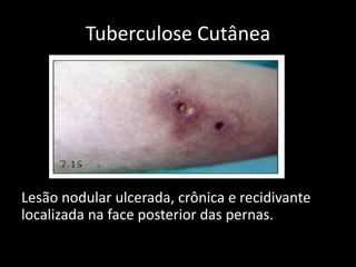 Tuberculose Cutânea
Lesão nodular ulcerada, crônica e recidivante
localizada na face posterior das pernas.
 