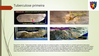 Tuberculose primeira
Peças R-41 e R-53. Tuberculose primária (nódulo de Ghon em pulmão de adulto). O nódulo de Ghon é o primeiro granuloma tuberculoso.
Geralmente ocorre na região subpleural do lobo médio (se for no pulmão direito) ou na região inferior do lobo superior ou superior do lobo inferior
(se for no pulmão esquerdo), porque as regiões médias dos pulmões são as áreas mais arejadas (portanto, a probabilidade de chegarem bacilos
aí é maior). Na grande maioria dos casos a lesão é pequena e de cura espontânea (detecção difícil). Aqui temos duas peças em que a lesão foi
maior. Na de cima, a delimitação é boa, mas há necrose caseosa central. Na de baixo, a lesão é maior e sua delimitação é menos precisa.
 