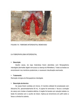 FIGURA 19 - FIBROMA INTERDIGITAL REMOVIDO
6.4 FIBROPAPILOMA INTERDIGITAL
Descrição
Quatro vacas, da raça holandesa foram atendidas com fibropapiloma
interdigital (dermatite digital verrucosa ou doença do Mortellaro). Todas as lesões se
encontravam nos membros posteriores, e causavam claudicação acentuada.
Tratamento
Remoção cirúrgica do fibropapiloma interdigital.
Descrição da técnica
As vacas foram contidas em tronco. O membro afetado foi anestesiado com
lidocaína 2%, aproximadamente 50 mL. A sujeira foi removida e fez-se a correção
do casco com rinetas e lixadeira elétrica. A região foi lavada com solução iodada e a
lesão foi extraída com o auxílio de bisturi. Aplicou-se terramicina em pó® sobre a
faixa e a ferida foi coberta.
 