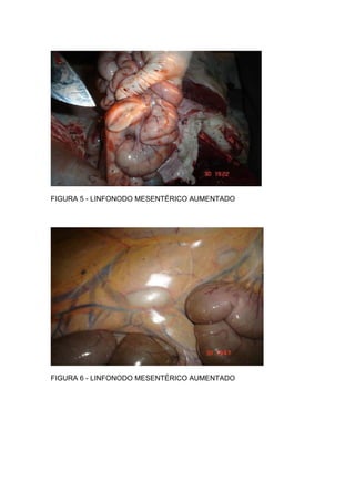 FIGURA 5 - LINFONODO MESENTÉRICO AUMENTADO
FIGURA 6 - LINFONODO MESENTÉRICO AUMENTADO
 