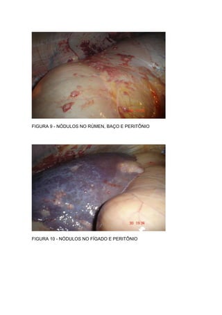 FIGURA 9 - NÓDULOS NO RÚMEN, BAÇO E PERITÔNIO
FIGURA 10 - NÓDULOS NO FÍGADO E PERITÔNIO
 