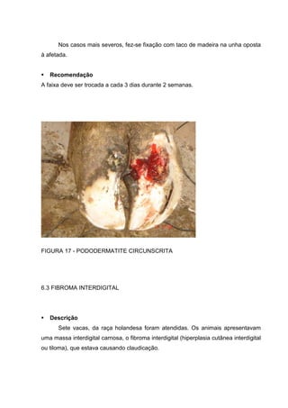 Nos casos mais severos, fez-se fixação com taco de madeira na unha oposta
à afetada.
Recomendação
A faixa deve ser trocada a cada 3 dias durante 2 semanas.
FIGURA 17 - PODODERMATITE CIRCUNSCRITA
6.3 FIBROMA INTERDIGITAL
Descrição
Sete vacas, da raça holandesa foram atendidas. Os animais apresentavam
uma massa interdigital carnosa, o fibroma interdigital (hiperplasia cutânea interdigital
ou tiloma), que estava causando claudicação.
 