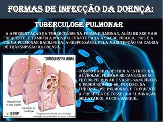 fORmaS DE INfECÇÃO Da DOENÇa:fORmaS DE INfECÇÃO Da DOENÇa:fORmaS DE INfECÇÃO Da DOENÇa:fORmaS DE INfECÇÃO Da DOENÇa:
a aPRESENTaÇÃO Da TUBERCULOSE Na fORma PULmONaR, aLém DE SER maIS
fREqUENTE, é TamBém a maIS RELEvaNTE PaRa a SaÚDE PÚBLICa, POIS é a
fORma PULmONaR BaCILífERa, a RESPONSávEL PELa maNUTENÇÃO Da CaDEIa
DE TRaNSmISSÃO Da DOENÇa.
TUBERCULOSE PULmONaRTUBERCULOSE PULmONaR
COmO O BaCILO DESTRÓI a ESTRUTURa
aLvEOLaR, fORmam-SE CavERNaS NO
TECIDO PULmONaR E vaSOS SaNgUíNEOS
E PODEm ROmPER-SE. POR ISSO, Na
TUBERCULOSE PULmONaR, é fREqUENTE
a PRESENÇa DE TOSSE COm ELImINaÇÃO
DE CaTaRRO, mUCO E SaNgUE.
 