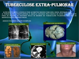 TUBERCULOSE ExTRa-PULmONaRTUBERCULOSE ExTRa-PULmONaR
aLém DOS PULmõES, a DOENÇa PODE aCOmETER ÓRgÃOS COmO RINS, OSSOS, mENINgES, ETC.
a TUBERCULOSE ExTRaPULmONaR é aqUELa CaUSaDa PELO BaCILO DE KOCH qUE INSTaLa-SE
fORa DO PULmÃO, OS SINTOmaS INCLUI OS mESmOS Da TUBERCULOSE PULmONaR, maS SEm aS
maNIfESTaÇõES RESPIRaTÓRIaS.
aBaIxO vEjamOS aLgUNS ExEmPLOS:
TUBERCULOSE vERTEBRaL
TUBERCULOSE NaS mENINgES
TUBERCULOSE RENaL TUBERCULOSE PLEURaL
TUBERCULOSE gaNgLIONaR
 