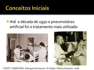  Até a década de 1950 o pneumotórax
artificial foi o tratamento mais utilizado
FONTE: TARANTINO. Doenças Pulmonares. 6ª edição. Editora Sextante. 2008.
 