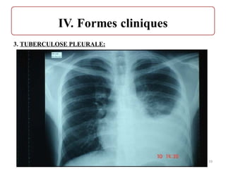 3. TUBERCULOSE PLEURALE:
33
 