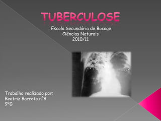 Tuberculose Escola Secundária de Bocage Ciências Naturais 2010/11 Trabalho realizado por: Beatriz Barreto nº8 9ºG 