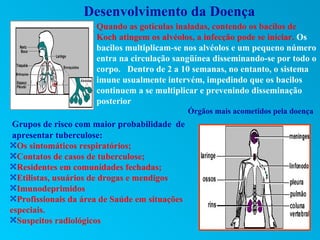 Desenvolvimento da Doença
                     Quando as gotículas inaladas, contendo os bacilos de
                     Koch atingem os alvéolos, a infecção pode se iniciar. Os
                     bacilos multiplicam-se nos alvéolos e um pequeno número
                     entra na circulação sangüínea disseminando-se por todo o
                     corpo. Dentro de 2 a 10 semanas, no entanto, o sistema
                     imune usualmente intervém, impedindo que os bacilos
                     continuem a se multiplicar e prevenindo disseminação
                     posterior
                                               Órgãos mais acometidos pela doença
 Grupos de risco com maior probabilidade de
 apresentar tuberculose:
0Os sintomáticos respiratórios;
0Contatos de casos de tuberculose;
0Residentes em comunidades fechadas;
0Etilistas, usuários de drogas e mendigos
0Imunodeprimidos
0Profissionais da área de Saúde em situações
especiais.
0Suspeitos radiológicos
 