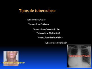 Tuberculose Ocular 
Tuberculose Cutânea 
Tuberculose Osteoarticular 
Tuberculose Abdominal 
Tuberculose Geniturinária 
Tuberculose Pulmonar 
 