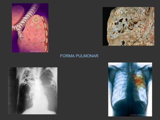 FORMA PULMONAR 