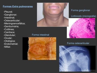 Formas Extra pulmonares Pleural; Ganglionar; Intestinal; Osteoarticular; Meningoencefálica; Geniturinária; Cutânea; Cardíaca; Glandular; Ocular; Otológica; Endometrial; Miliar. Forma ganglionar Linfonodo (micrografia) Forma intestinal Forma osteoarticular 