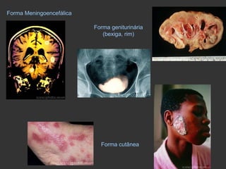 Forma cutânea Forma geniturinária (bexiga, rim) Forma Meningoencefálica 