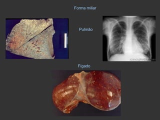 Forma miliar Pulmão Fígado 