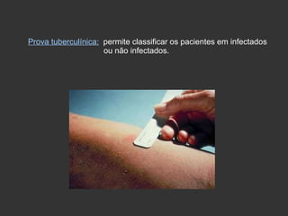 Prova tuberculínica:   permite classificar os pacientes em infectados  ou não infectados. 