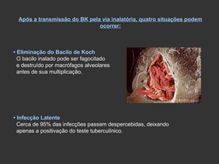 Após a transmissão do BK pela via inalatória, quatro situações podem ocorrer: •  Eliminação do Bacilo de Koch O bacilo inalado pode ser fagocitado e destruído por macrófagos alveolares antes de sua multiplicação. •   Infecção Latente Cerca de 95% das infecções passam despercebidas, deixando  apenas a positivação do teste tuberculínico. 