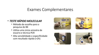 • TESTE RÁPIDO MOLECULAR
• Método de escolha para a
pesquisa de BK
• Utiliza uma única amostra de
escarro e técnica PCR
• Alta sensibilidade e especificidade
com resultado rápido (≈2h)
Exames Complementares
 