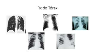 Rx do Tórax
 